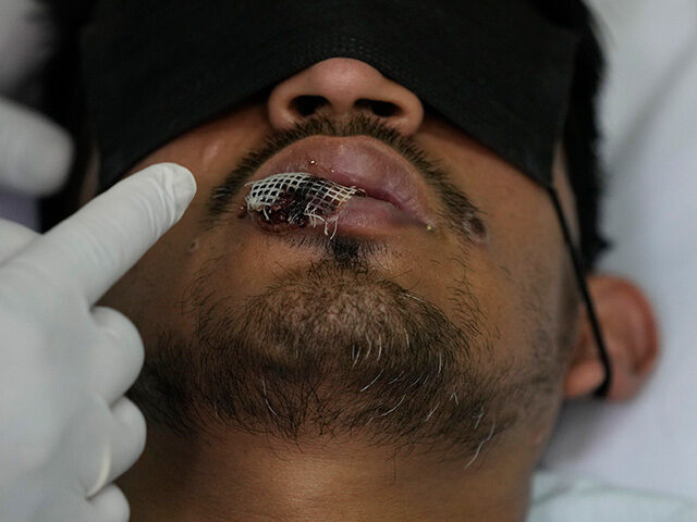 A doctor shows a monkeypox sore on a patient´s lip, at the Arzobispo Loayza hospital in L