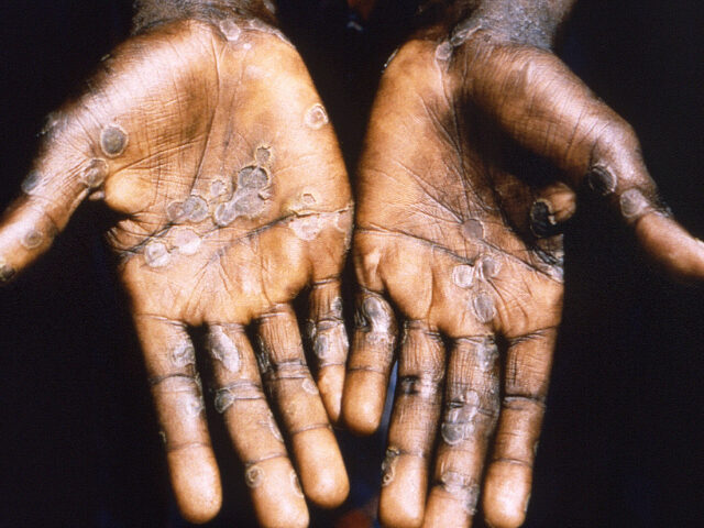 Palms of a patient with a case of monkeypox